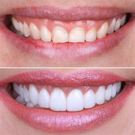 Veneers in Turkey .